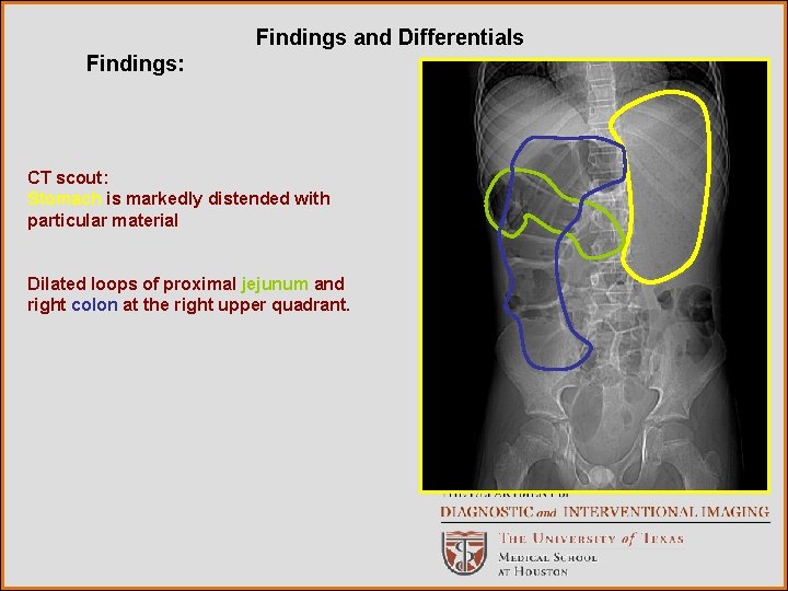 Findings and Differentials Findings: CT scout: Stomach is markedly distended with particular material Dilated