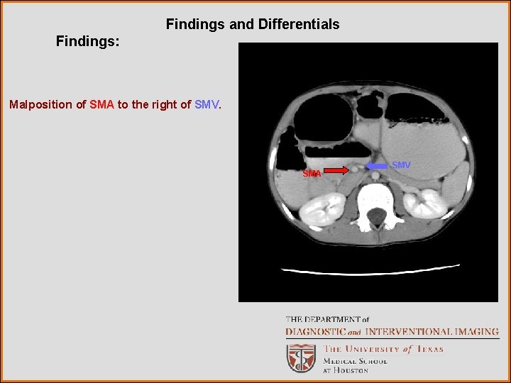 Findings and Differentials Findings: Malposition of SMA to the right of SMV. SMA SMV