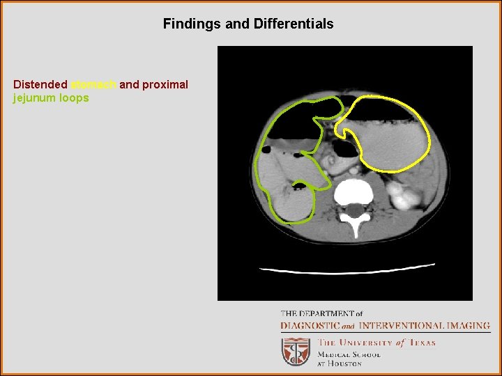 Findings and Differentials Distended stomach and proximal jejunum loops 