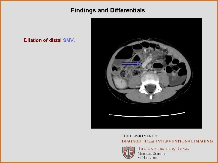 Findings and Differentials Dilation of distal SMV. 