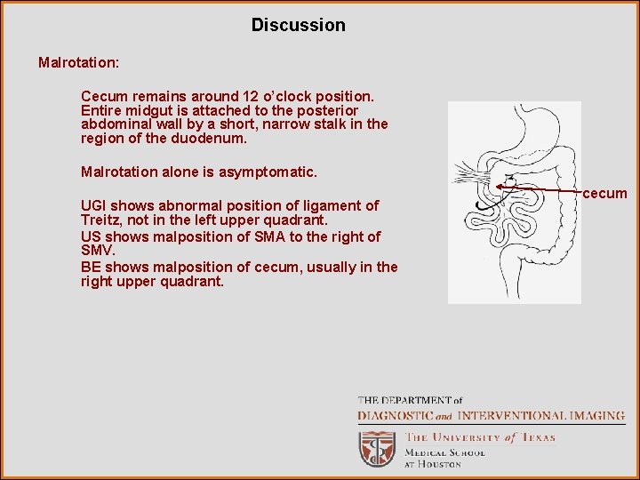 Discussion Malrotation: Cecum remains around 12 o’clock position. Entire midgut is attached to the