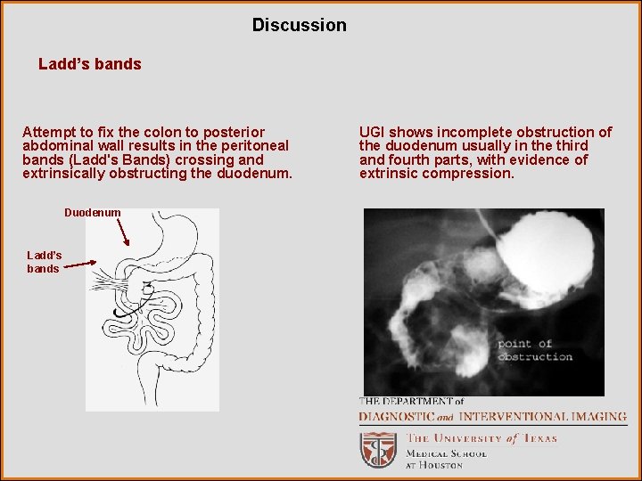 Discussion Ladd’s bands Attempt to fix the colon to posterior abdominal wall results in