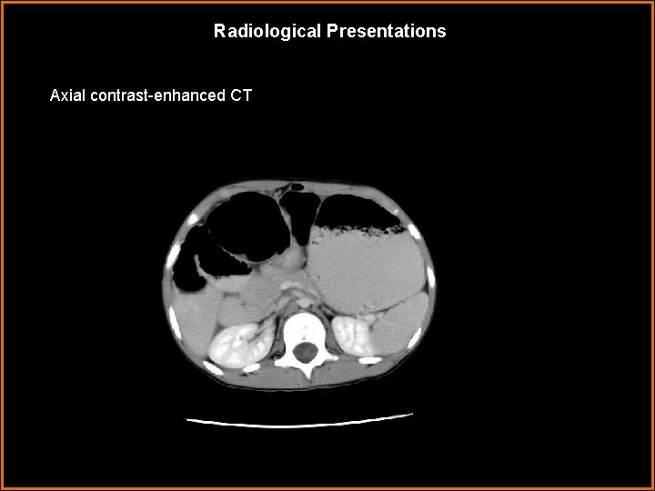 Radiological Presentations Axial contrast-enhanced CT 
