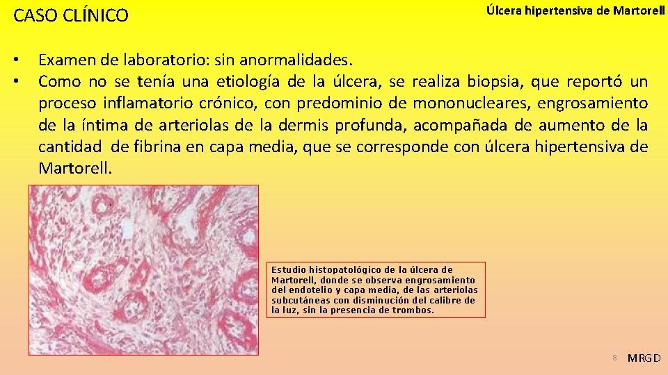 CASO CLÍNICO • • Úlcera hipertensiva de Martorell Examen de laboratorio: sin anormalidades. Como