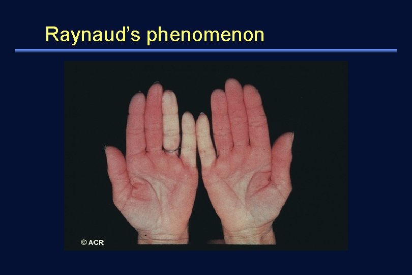 Raynaud’s phenomenon 