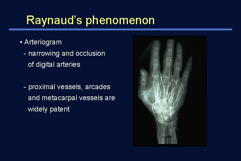 Raynaud’s phenomenon • Arteriogram - narrowing and occlusion of digital arteries - proximal vessels,