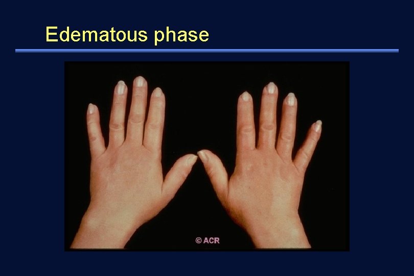 Edematous phase 