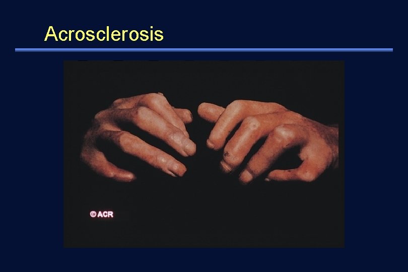 Acrosclerosis 