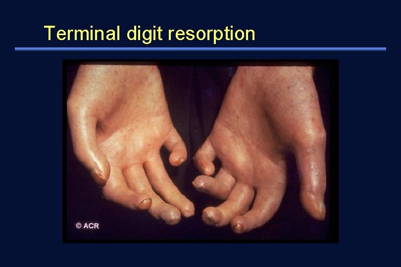 Terminal digit resorption 