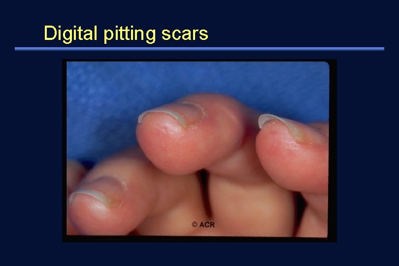 Digital pitting scars 