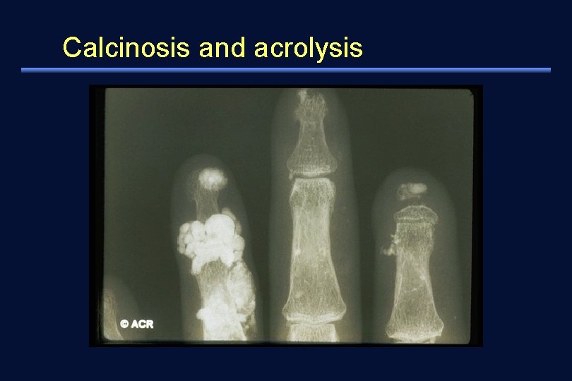 Calcinosis and acrolysis 