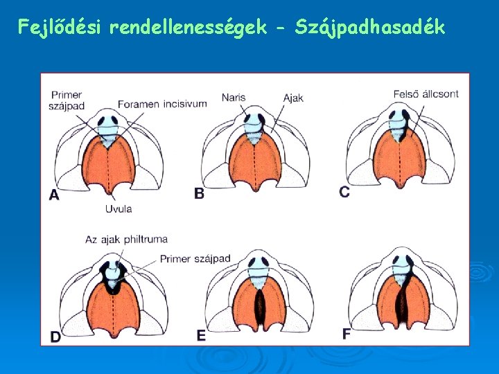 Fejlődési rendellenességek - Szájpadhasadék 