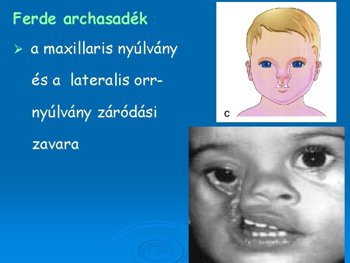 Ferde archasadék : Ø a maxillaris nyúlvány és a lateralis orrnyúlvány záródási zavara 