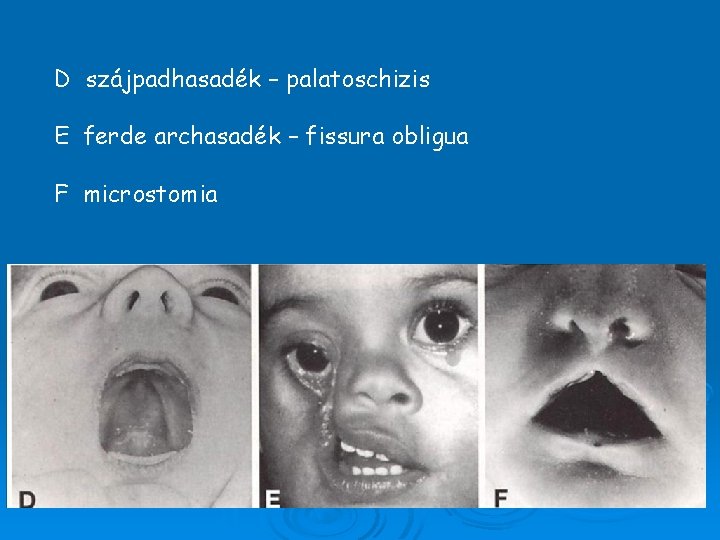 D szájpadhasadék – palatoschizis E ferde archasadék – fissura obligua F microstomia 