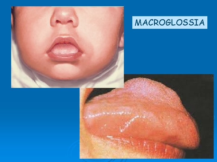 MACROGLOSSIA 