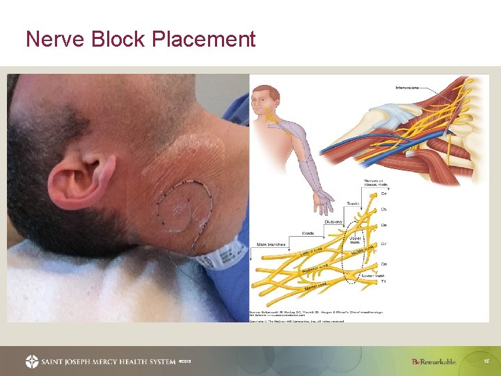 Nerve Block Placement © 2015 15 