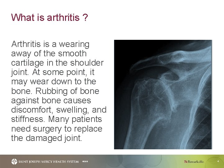 What is arthritis ? Arthritis is a wearing away of the smooth cartilage in