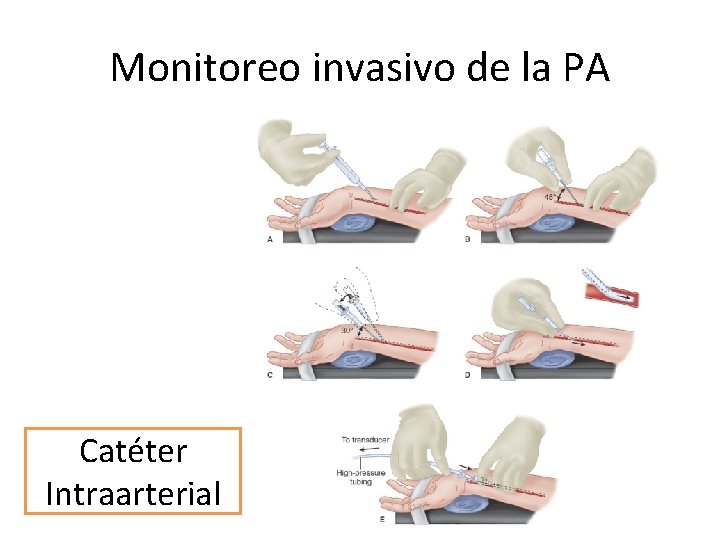 Monitoreo invasivo de la PA Catéter Intraarterial 