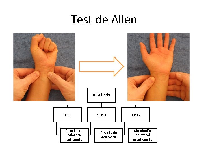 Test de Allen Resultado <5 s Circulación colateral suficiente 5 -10 s Resultado equivoco