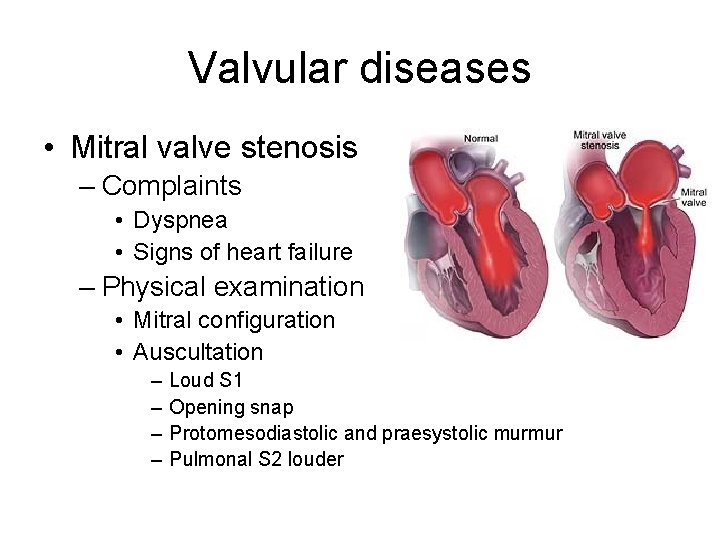 Valvular diseases • Mitral valve stenosis – Complaints • Dyspnea • Signs of heart Valvular diseases • Mitral valve stenosis – Complaints • Dyspnea • Signs of heart