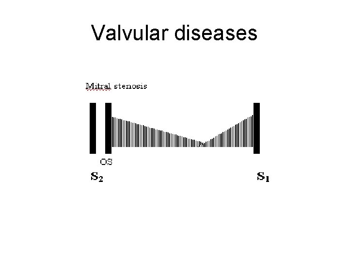 Valvular diseases Valvular diseases