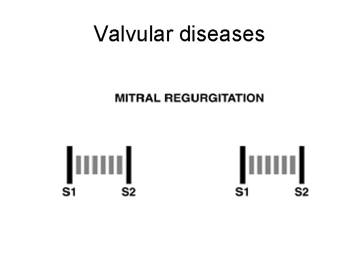 Valvular diseases Valvular diseases