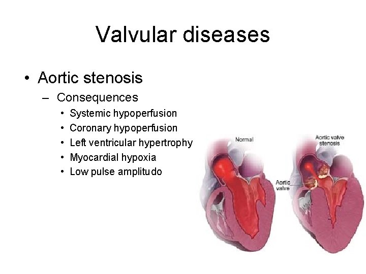 Valvular diseases • Aortic stenosis – Consequences • • • Systemic hypoperfusion Coronary hypoperfusion Valvular diseases • Aortic stenosis – Consequences • • • Systemic hypoperfusion Coronary hypoperfusion
