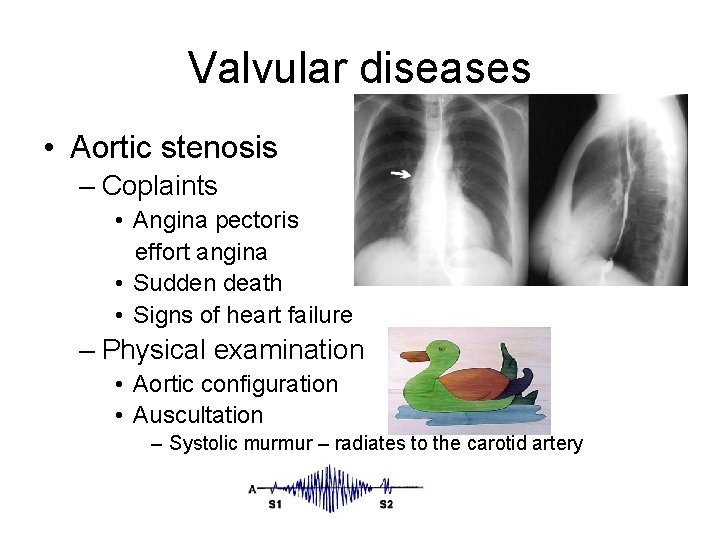 Valvular diseases • Aortic stenosis – Coplaints • Angina pectoris effort angina • Sudden Valvular diseases • Aortic stenosis – Coplaints • Angina pectoris effort angina • Sudden
