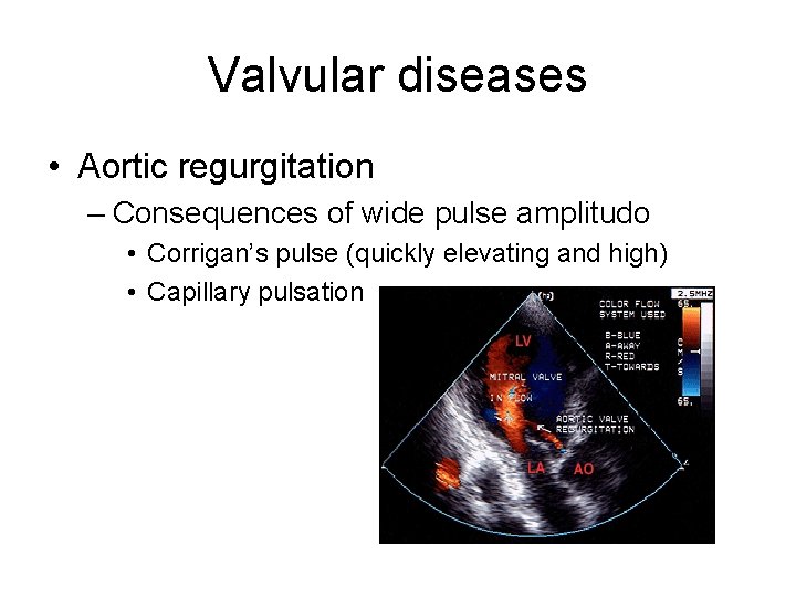 Valvular diseases • Aortic regurgitation – Consequences of wide pulse amplitudo • Corrigan’s pulse Valvular diseases • Aortic regurgitation – Consequences of wide pulse amplitudo • Corrigan’s pulse
