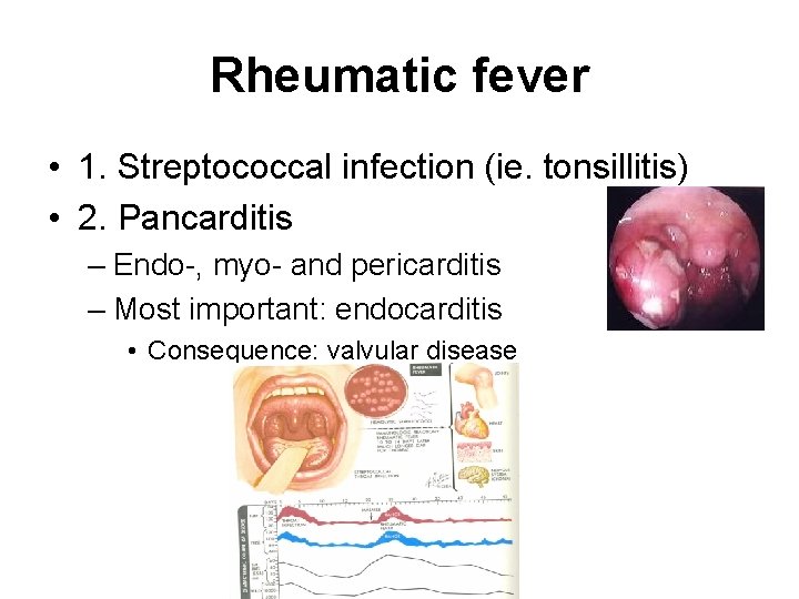 Rheumatic fever • 1. Streptococcal infection (ie. tonsillitis) • 2. Pancarditis – Endo-, myo- Rheumatic fever • 1. Streptococcal infection (ie. tonsillitis) • 2. Pancarditis – Endo-, myo-