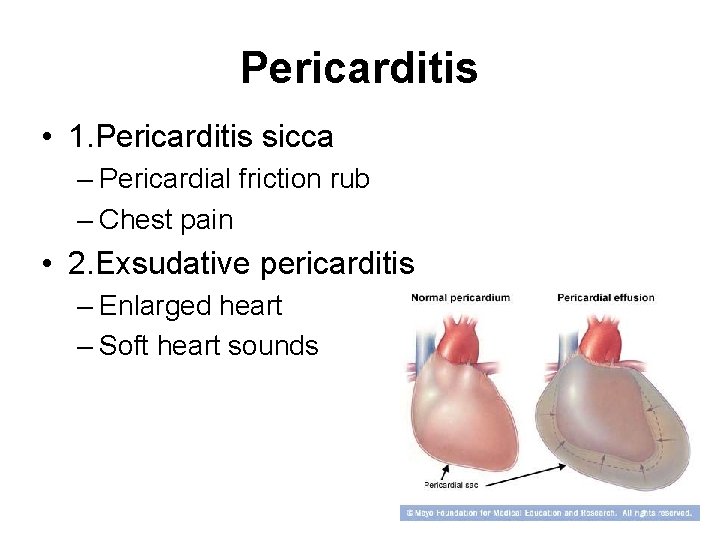 Pericarditis • 1. Pericarditis sicca – Pericardial friction rub – Chest pain • 2. Pericarditis • 1. Pericarditis sicca – Pericardial friction rub – Chest pain • 2.