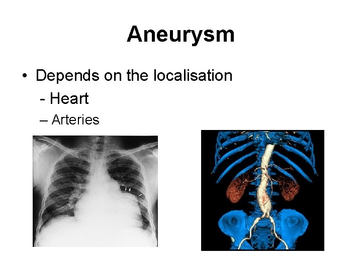 Aneurysm • Depends on the localisation - Heart – Arteries Aneurysm • Depends on the localisation - Heart – Arteries
