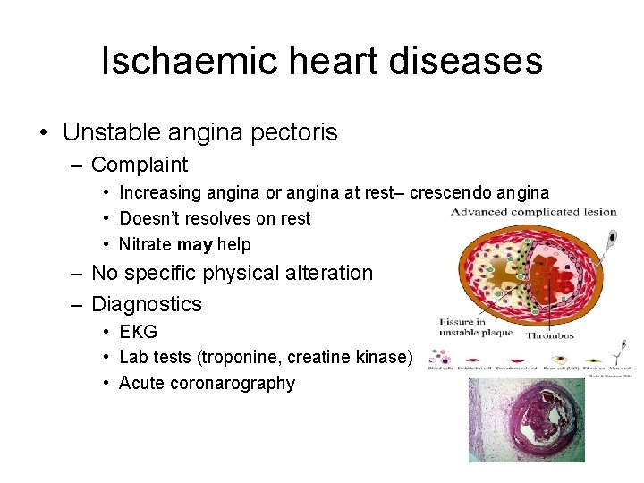 Ischaemic heart diseases • Unstable angina pectoris – Complaint • Increasing angina or angina Ischaemic heart diseases • Unstable angina pectoris – Complaint • Increasing angina or angina