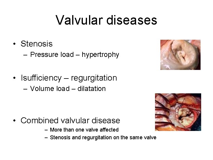 Valvular diseases • Stenosis – Pressure load – hypertrophy • Isufficiency – regurgitation – Valvular diseases • Stenosis – Pressure load – hypertrophy • Isufficiency – regurgitation –