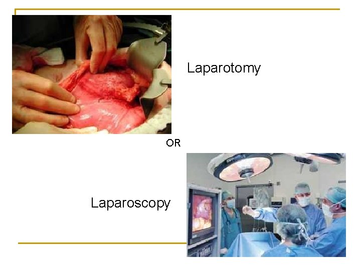 Laparotomy OR Laparoscopy 