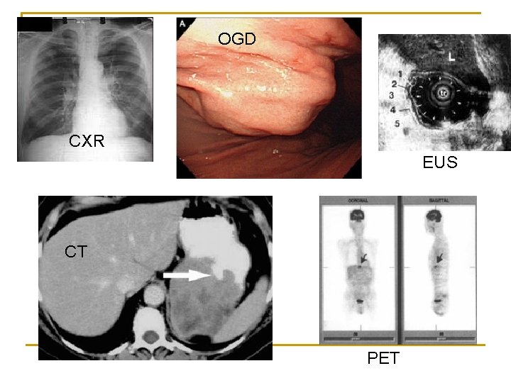 OGD CXR EUS CT PET 