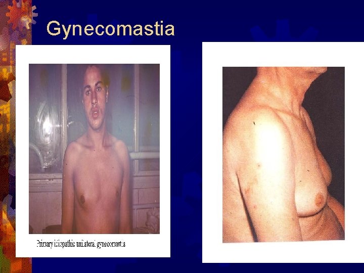 Gynecomastia 