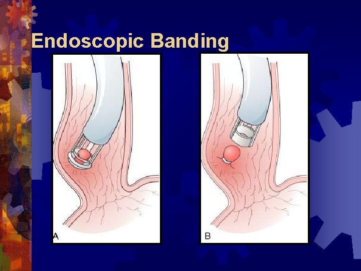 Endoscopic Banding 