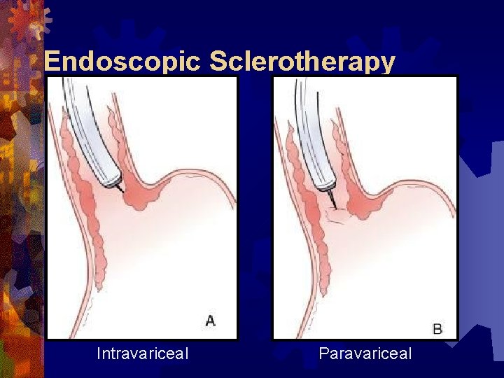 Endoscopic Sclerotherapy Intravariceal Paravariceal 