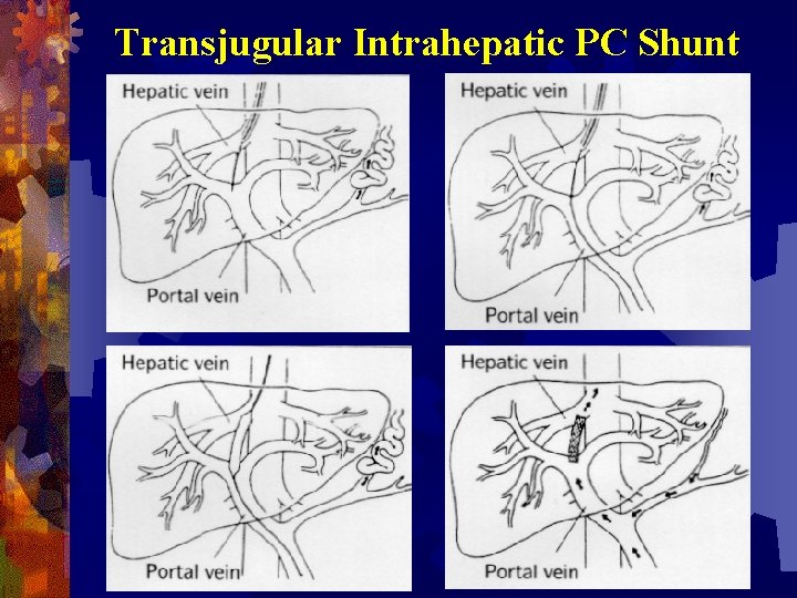 Transjugular Intrahepatic PC Shunt 