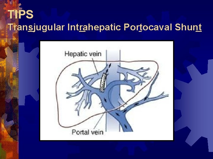 TIPS Transjugular Intrahepatic Portocaval Shunt 