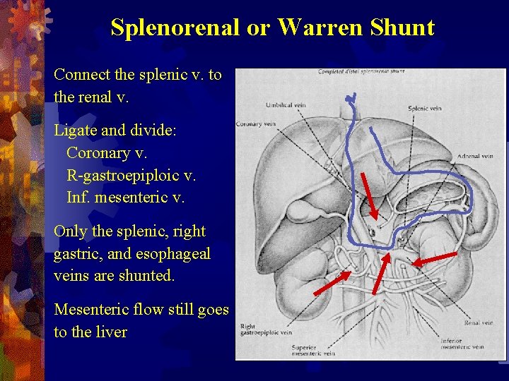 Splenorenal or Warren Shunt Connect the splenic v. to the renal v. Ligate and