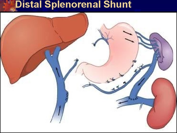 Distal Splenorenal Shunt 