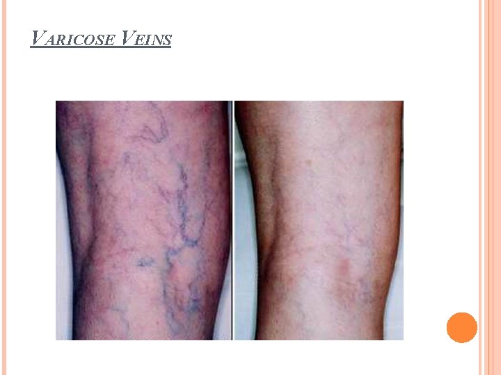 VARICOSE VEINS 