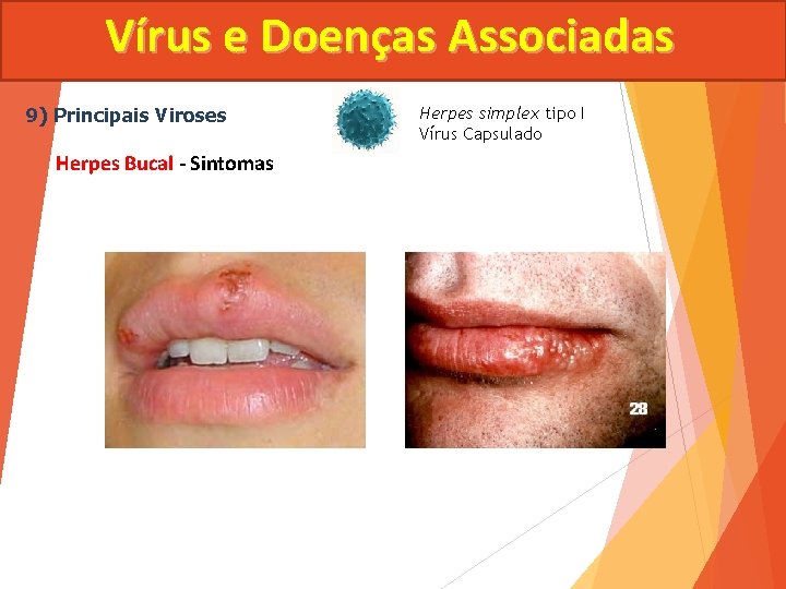 Vírus e Doenças Associadas 9) Principais Viroses Herpes Bucal - Sintomas Herpes simplex tipo