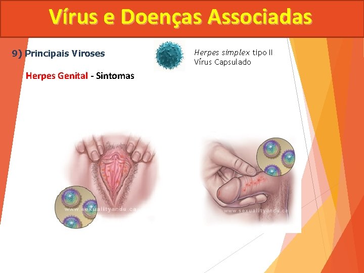 Vírus e Doenças Associadas 9) Principais Viroses Herpes Genital - Sintomas Herpes simplex tipo