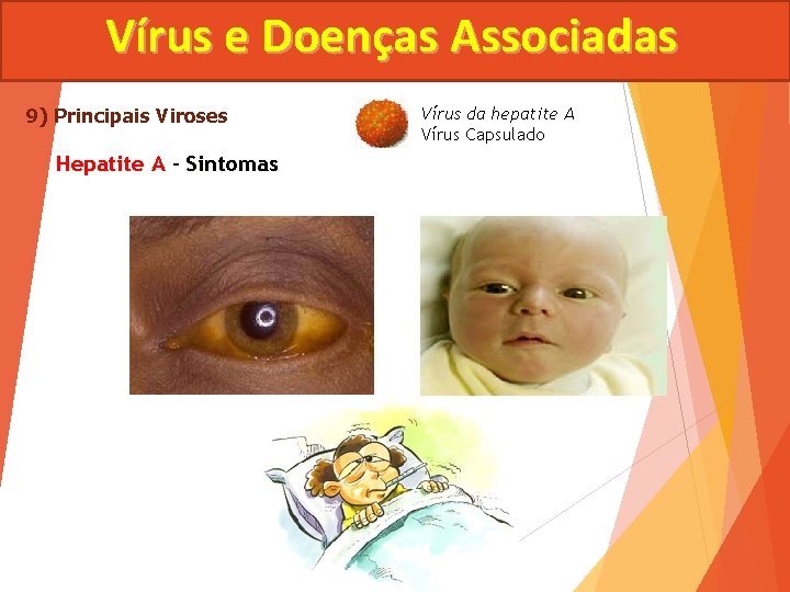 Vírus e Doenças Associadas 9) Principais Viroses Hepatite A - Sintomas Vírus da hepatite