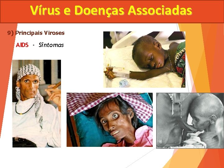 Vírus e Doenças Associadas 9) Principais Viroses AIDS - Sintomas 