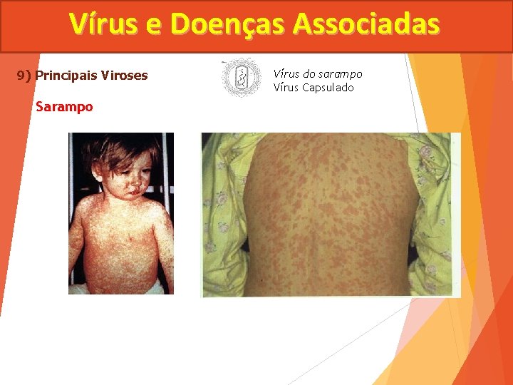 Vírus e Doenças Associadas 9) Principais Viroses Sarampo Vírus do sarampo Vírus Capsulado 