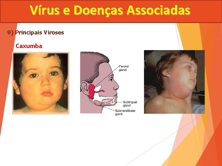 Vírus e Doenças Associadas 9) Principais Viroses Caxumba 